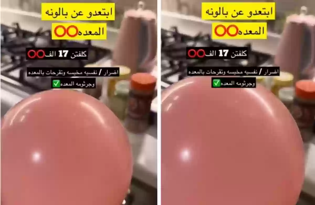 سعودية تشارك تجربة بالون المعدة